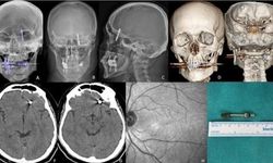 Beynine saplanan implant hayatını kararttı