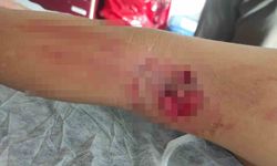 Okula giderken sokak köpeğinin saldırısına uğradı