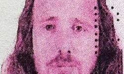 Saç ekimi ve diş tedavisi ardından hayatını kaybetti