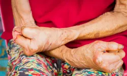 Hırvatistan'da ve Romanya'da cüzzam paniği