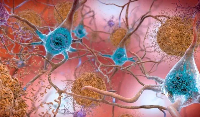 Araştırmacılardan Alzheimer'a karşı yeni yöntem