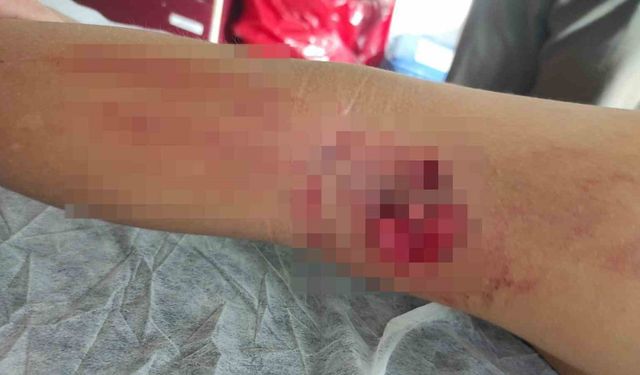 Okula giderken sokak köpeğinin saldırısına uğradı