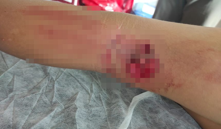 Okula giderken sokak köpeğinin saldırısına uğradı