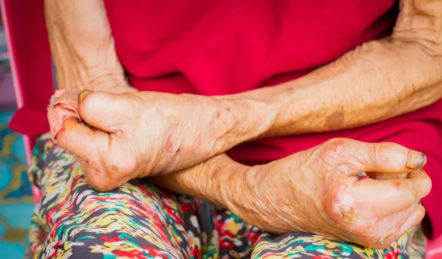 Hırvatistan'da ve Romanya'da cüzzam paniği