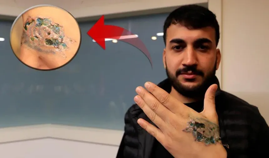 Dövme sildirmek isteyen genç kabusu yaşadı!