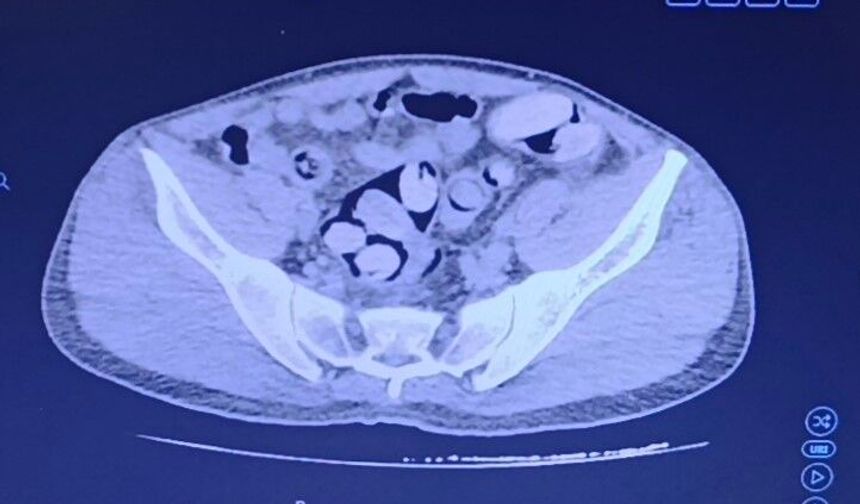 Midesinden 1 kilodan fazla uyuşturucu çıktı